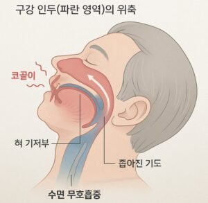 코골이